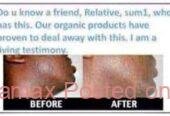 Get rid of acne scars, skin lightening creams in Mbombela+27 81 850 2816