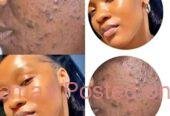 Get rid of acne scars, skin lightening creams in Mbombela+27 81 850 2816