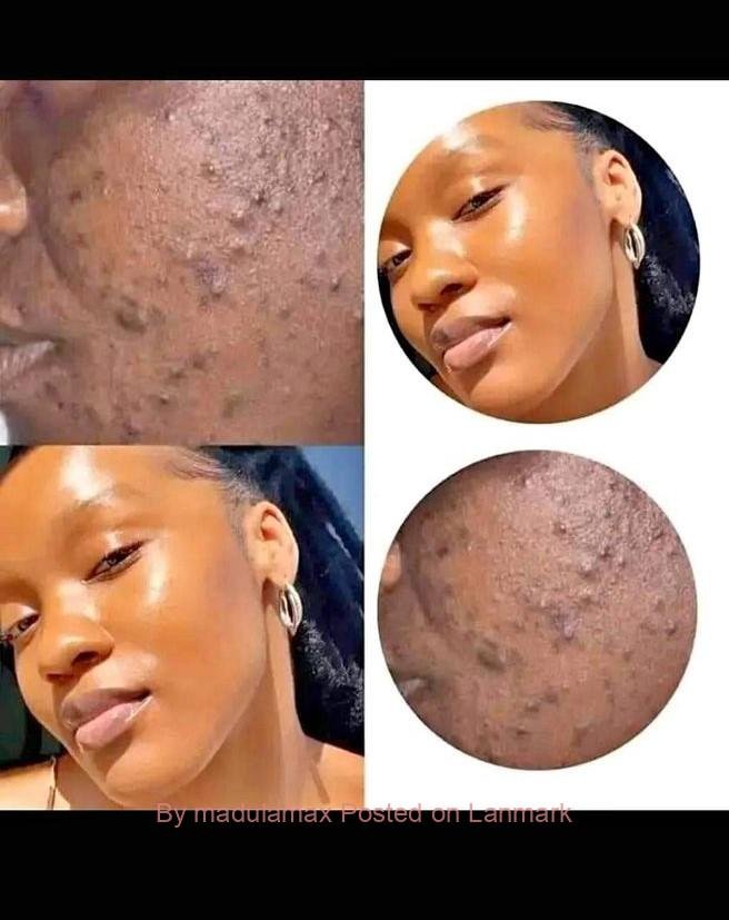 Get rid of acne scars, skin lightening creams in Mbombela+27 81 850 2816