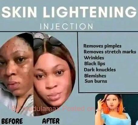 Permanent skin lightening pills or injection in Polokwane+27 81 850 2816