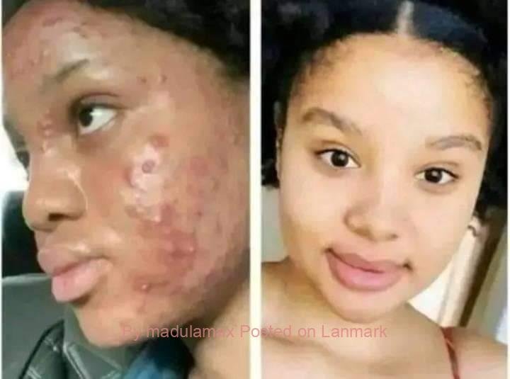 Skin whitening cream and pills in Bhisho+27 81 850 2816