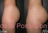 PMMA and Hydrogel Buttocks injections+27 74 676 7021