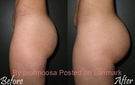 PMMA and Hydrogel Buttocks injections+27 74 676 7021