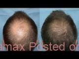 Nuviante hair growth nutritional supplements in Durban+27 81 850 2816